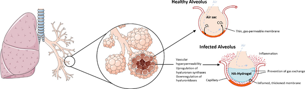 Hyaluronic Acid gel filling the alveoli